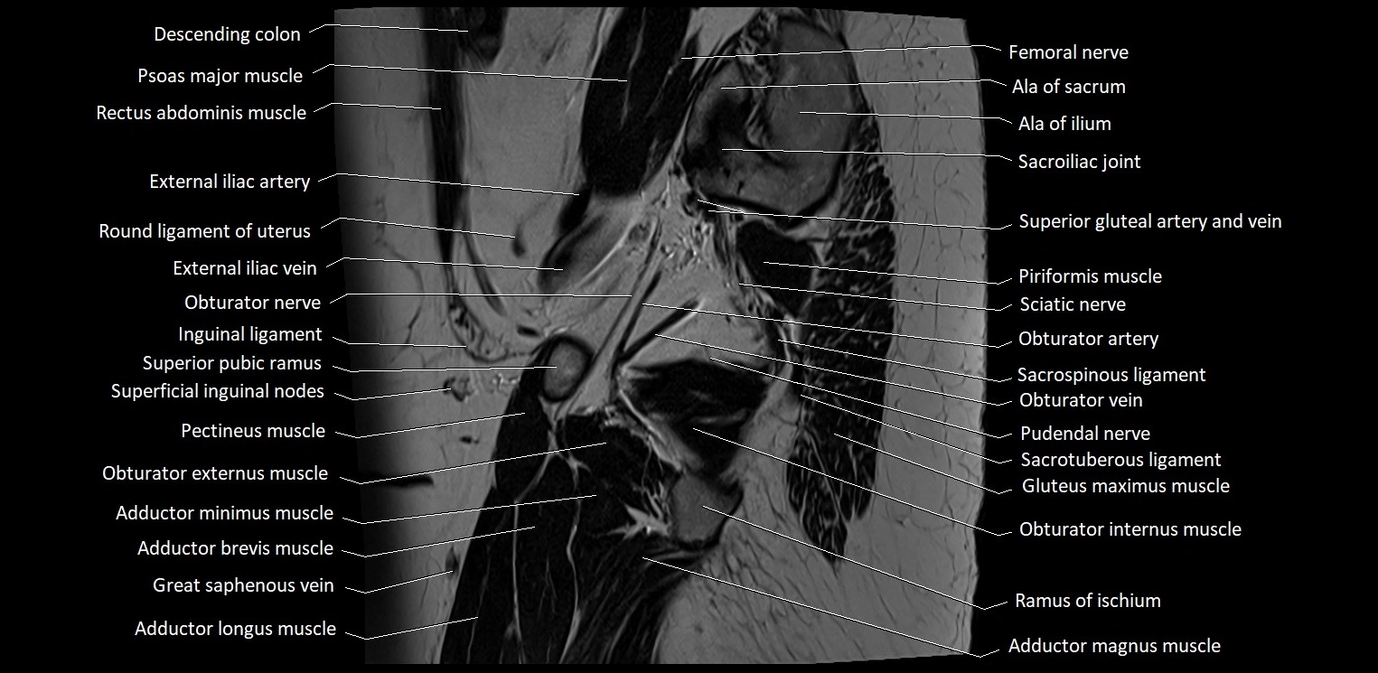 Sagittal cross sectional anatomy of female pelvis (MRI 3T) image 37.webp
